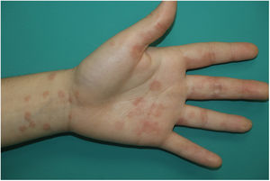 Nonspecific rash, with perifollicular distribution in a patient with COVID-19.