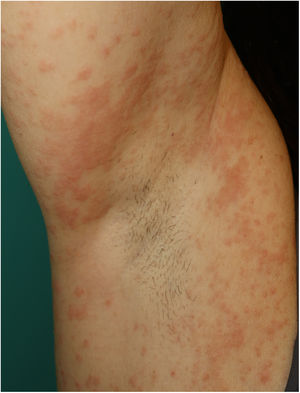 Multiform erythema-like eruption in a patient with SARS-CoV-2 infection.