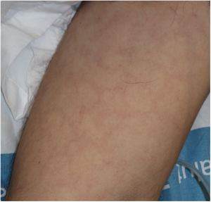 Livedoid rash with a transient course on the trunk of a patient with severe COVID-19.