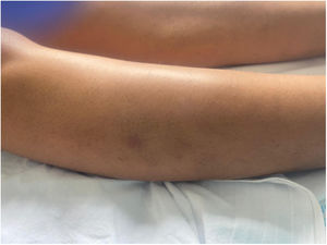 Nodular lesion (2 cm in diameter) with a brownish surface located on the outer aspect of the right leg.