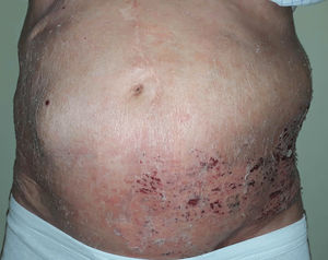 Pseudohernia on the left flank coinciding with herpes zoster in the crusting phase.