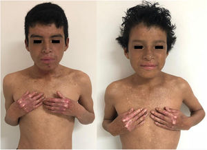 Clinical characteristics of Cases 1 (left) and 2 (right). Dry skin, atrophic areas with hypopigmentation and hyperpigmentation (poikiloderma), and multiple freckles located predominantly in photo-exposed areas. Both patients presented with pseudosyndactyly of the hands.