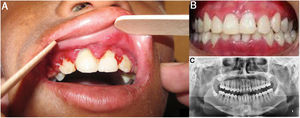 Clinical manifestations in Cases 3 and 4. Both patients presented with skin atrophy, hypochromic and hyperchromic areas with multiple telangiectasias (poikiloderma), and freckles predominantly in photo-exposed areas, as well as conjunctivitis and mild bilateral ectropion of the lower eyelid (right-hand image).