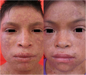 Case 1. Electron microscopy. Serial ultrafine sections (100-nm thick) showing blisters (arrows) at different levels of the dermo-epidermal junction, with desmosomes and anchoring fibrils without alterations.