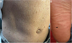 Clinical manifestations. A, Case 2. Dry skin with atrophic areas with a cigarette-paper-like appearance and multiple freckles. B, Case 3. Plantar pitting.