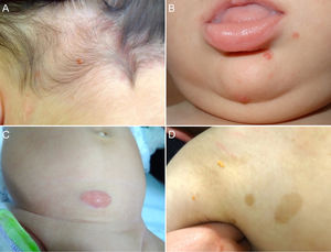 A, One-year-old boy with a solitary juvenile xanthogranuloma (JXG) lesion in the occipital region. B, Eight-month-old boy with multiple congenital JXG lesions on his chin. C, Four-month-old girl with a giant congenital JXG lesion on her abdomen. D, JXG associated with café au lait spots in a 4-year-old boy with neurofibromatosis type 1.