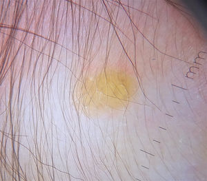 Dermatoscopy showing a pale lesion with an erythematous halo (setting sun pattern).
