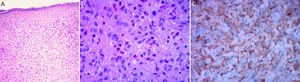 Skin biopsy. A and B, Dermal histiocytic and eosinophilic infiltrate (hematoxylin-eosin, original magnification × 40x and 100x, respectively). C, Immunohistochemistry. CD68+ marker.
