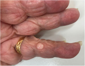 Well-demarcated nodule measuring 7 × 5.7 mm with superficial vascularization.