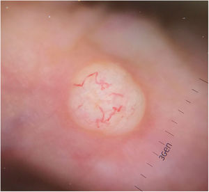Homogeneous white lesion with perilesional erythema and peripheral arborizing vessels.