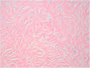 Abundant hypocellular hyalinized bands of collagen and clefts forming a storiform pattern.
