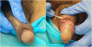 Lymphogranuloma venereum on the penis of an HIV-positive patient. Abscess in the area of the prepuce with a fistula to the skin.