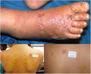 A, Eczema-like lesions on the dorsal surface of both feet (Case 1). B, Positive epicutaneous tests (D4) for tea tree oil and for colophony (Case 1).