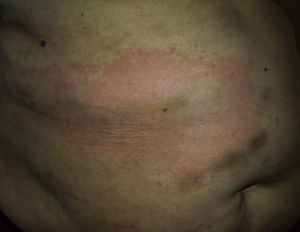 A large semicircular erythematous plaque with a clearly demarcated papular margin and central lightening, located on the abdomen.