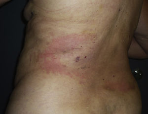 Appearance of the lesion during the first episode, 9 years earlier. The initial lesion already showed a semicircular distribution with clearly defined edges and central lightening.