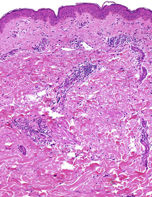 The biopsy shows a perivascular inflammatory infiltrate composed mainly of lymphocytes, which involves the superficial and middle dermis (hematoxylin–eosin).