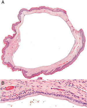 A, Hematoxylin–eosin x2. B, Hematoxylin–eosin x20.