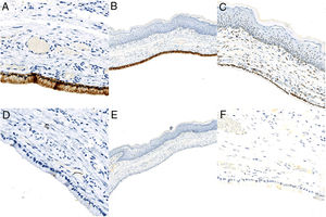 A, EMA x20. B, CK7×4. C, Estrogen receptor x10. D, Progesterone receptor x20. E, CK20×4. F, CEA x20.