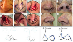 Clinical images that show the surgical technique for performing the crescentic nasojugal flap (1-6) and the postoperative outcome after 1 month (7-10). Bottom left: Image from the article by Smadja1 showing the schematic of the crescentic nasojugal flap. Bottom right: Image from the article by Hussain7 showing the scars resulting from performing crescentic nasojugal flap (B)1 and the sine wave flap (D).7