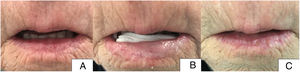 Patient 3. A, Initial state of the patient before treatment, with involvement of 75% of the surface of the lower lip (central region and adjacent lateral areas). B, Image of patient with methyl aminolevulinate cream applied and gauze on the posterior face of the lower lip. C, Image of the patient after 8 weeks of treatment. Complete resolution of the lesions.