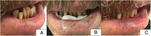 Patient 4. A, Initial situation of the patient before treatment with involvement of 75% of the surface of the lower lip (right lateral and central region). B, Image of patient with methyl aminolevulinate cream applied and gauze on the posterior face of the lower lip. C, Image of the patient after 8 weeks of treatment. Complete resolution of the lesions.