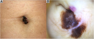A, Clinical image showing an asymmetric melanocytic lesion with irregular borders and heterochromia. B, Dermoscopic image showing a melanocytic lesion with an atypical pigment network, blue-gray dots, and whitish areas.