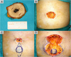 A, Wide excision of the lesion with 2-cm margins. B, Surgical defect (40 × 30 mm). C, Planning of reconstruction using an island pedicle flap. The minor axis of the spindle-shaped incision is calculated to ensure a transitory tobacco-pouch closure (x). The major axis is 3 times the length of the minor axis (3x) and runs along the midline of the defect (gray dashed line). D, The tobacco pouch is released, and the lateral triangles are removed, leaving a circular skin island that is dissected together with an adipose pedicle that enables its movement to the desired position.