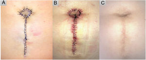 The island is moved to the desired position and fixed to the anterior sheath of the rectus abdominis muscle with a transfixing U-stitch to give it a conical shape. The skin surrounding the neo-umbilicus is sutured with loose stitches and the remainder with a continuous running suture. A, Immediate postoperative result. B, After suture removal, 14 days later. C, Ten months after the surgical intervention.