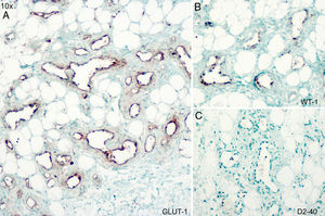 Immunohistochemistry for glucose transporter 1 (GLUT1) (A), Wilms tumor 1 (WT1) (B), and D2-40 (C); original magnification ×10.