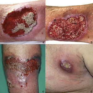 A, Ulcerative pyoderma gangrenosum on the right leg (April 2005). B, Ulcerative pyoderma gangrenosum on the right leg (October 2009). C, Detail of ulcerative pyoderma gangrenosum lesion (10 × 6 cm) on the left leg (July 2015). D, Ulcerative pyoderma gangrenosum in the left armpit (May 2017).
