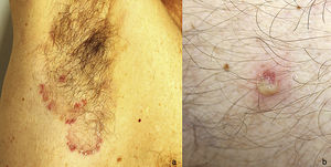 A, Erythematous papules with a scaly surface and pustules grouped at the edge of polycyclic plaques located in the right armpit. B, Detail of a flaccid pustule corresponding to a subcorneal pustular dermatosis lesion.