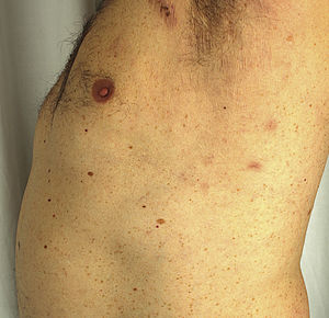 Residual macules in the left armpit corresponding to subcorneal pustular dermatosis lesions 3 weeks after starting treatment with adalimumab.