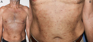Clinical image. Erythematous and brown papules on both sides of the patient’s trunk.