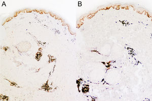 Immunohistochemistry images showing positive staining for κ (A) and λ (B) immunoglobulin light chains.