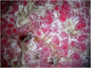 Dermoscopy image. Rounded and oval structures of variable size with an erythematous center and pinkish periphery, separated from one other by yellowish scales.