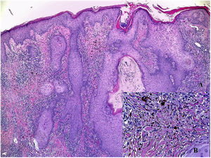 Histopathological image. A, Epidermal hyperplasia, hyperkeratosis of the corneal layer, and pigment deposition in the superficial dermis accompanied by inflammatory infiltrate (hematoxylin-eosin, original magnification ×4). B, Detail of pigment deposits inside histiocytes and extracellular cells, accompanied by lymphohistiocytic infiltrate (hematoxylin-eosin, original magnification ×40).