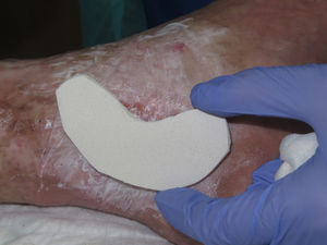 Retromalleolar padding.