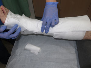 Padding to protect areas sensitive to excessive pressure (pretibial region, lateral aspect of the foot, Achilles tendon).