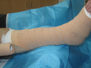 Multicomponent bandage (2-bandage system with circular pressure indicators).