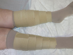 Self-adjusting pressure system with a Velcro closure.