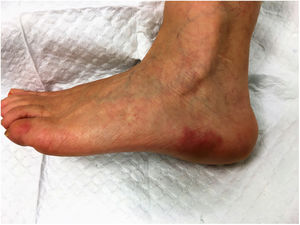 Well defined erythematoviolaceous plaques on the outer side of the left foot.