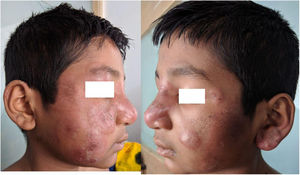 A, B: Erythematous and edematous plaques over the face, some of them showing slight vesiculations.