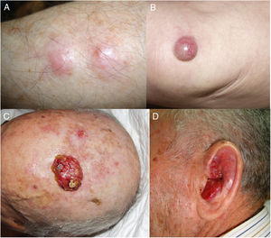 A, Clinical presentation of Merkel cell carcinoma in 4 patients in the form of subcutaneous nodular lesions. B, Isolated erythematous tumor. C and D, Two ulcerated lesions (friable surface).