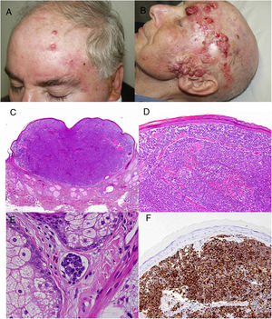 A, Satellite metastases in a patient with Merkel cell carcinoma immediately after surgery to treat the primary tumor. B, Patient with locally advanced Merkel cell carcinoma. C–F Histopathology study of Merkel cell carcinoma; perinuclear dot-like pattern in cytokeratin 20 staining.