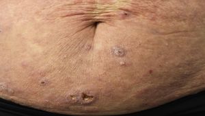 Erythroderma in a patient with Sézary syndrome.