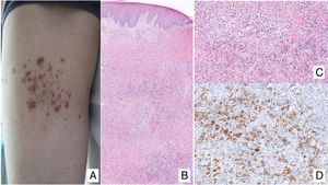 A, Papules at different stages of development corresponding to lymphomatoid papulosis (LP). B, Dermal infiltrate formed of atypical lymphocytes and rich in eosinophils from a papular LP lesion. C, Large-cell lymphocytes with nuclear pleomorphism in an LP lesion. D, Expression of CD30 antigen in large lymphocytes with an activated appearance in LP.