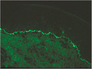 Direct immunofluorescence image showing linear deposition of immunoglobulin G along the dermal-epidermal junction.