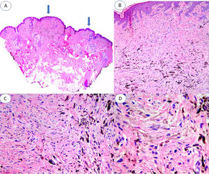 A, Panoramic image of the lesion in which 2 areas of blue nevus are evident (arrows), one of about 3 mm and the other of about 1 mm. B, Compact nests of spindle-shaped melanocytes located in the papillary and superficial reticular dermis without the presence of nests at the dermoepidermal junction (hematoxylin-eosin [HE], original magnification ×4). C, Detail of melanin distribution, with denser granules visible in the deepest part of the lesion (HE, original magnification ×10). D, Detail of melanocytes, showing monomorphic nuclei and the absence of mitosis and necrosis (HE, original magnification ×20).