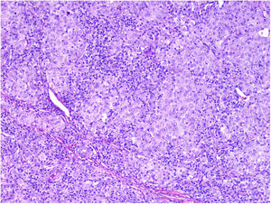Detail of intense intratumoral lymphocytic infiltrate. Hematoxylin-eosin, original magnification ×100.