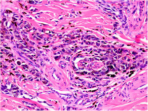Intraneural invasion by melanoma cells (neurotropism). Hematoxylin-eosin, original magnification ×200.